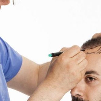 Best Hair Transplant Doctors