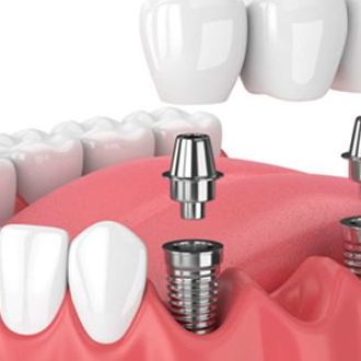 Dental Crown Treatment