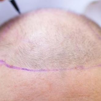 Hair Transplant Surgery